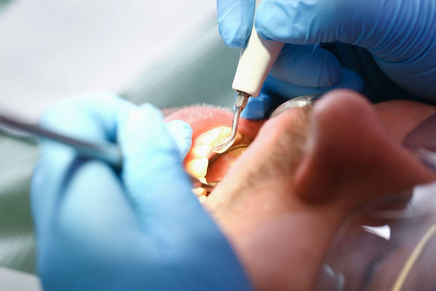 Best Emergency Root Canal Therapy in Lafayette, IN