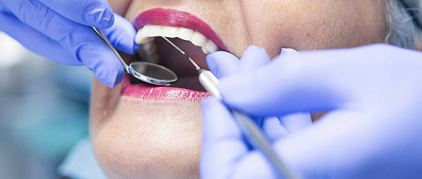 Best Broken or Chipped Tooth Repair in Lafayette, IN